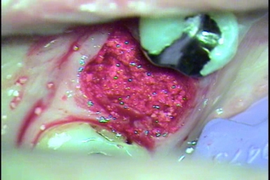 抜歯窩に置いたリフィットRFTデンタルが血液を十分に吸った写真