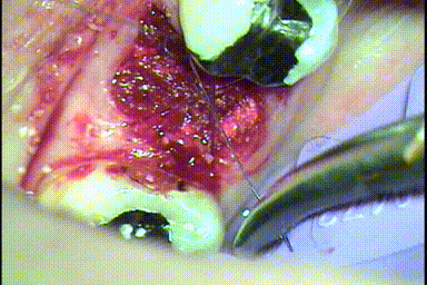 抜歯後にソケットプリザーベーションを行い吸収性縫合糸でHiddenXヒドゥンエックス縫合するGIF動画