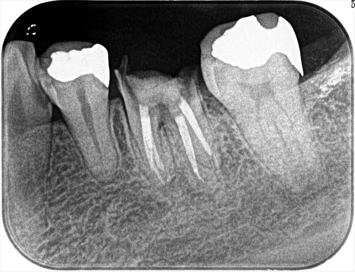 むし歯によって歯が消えかけて写っている左下第一大臼歯のレントゲン写真