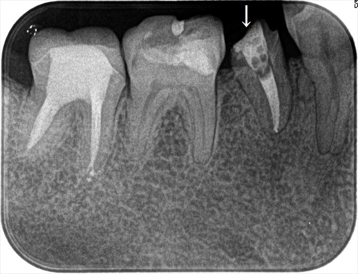 右下第二小臼歯の垂直根管充填を終えた後の確認のレントゲン写真