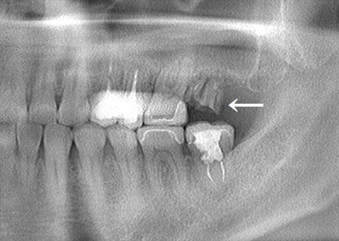 ボロボロに朽ちている左上奥歯第二大臼歯のパノラマレントゲン写真