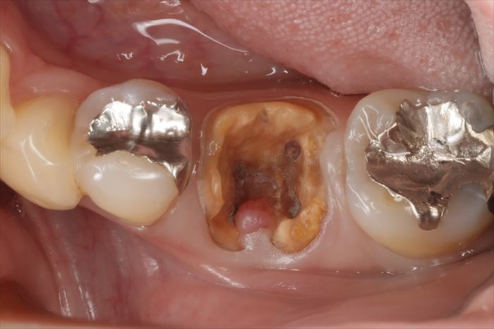 むし歯が進み歯根分岐部に歯肉が入り込んできている左下第一大臼歯の咬合面観の写真