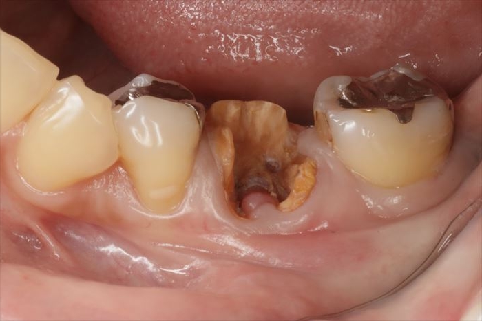 むし歯が進み歯根分岐部に歯肉が入り込んできている左下第一大臼歯の頬側面観の写真