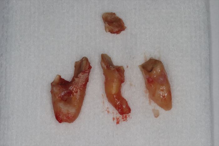 3根性の左下第一大臼歯を分割抜歯したあとの歯根の写真