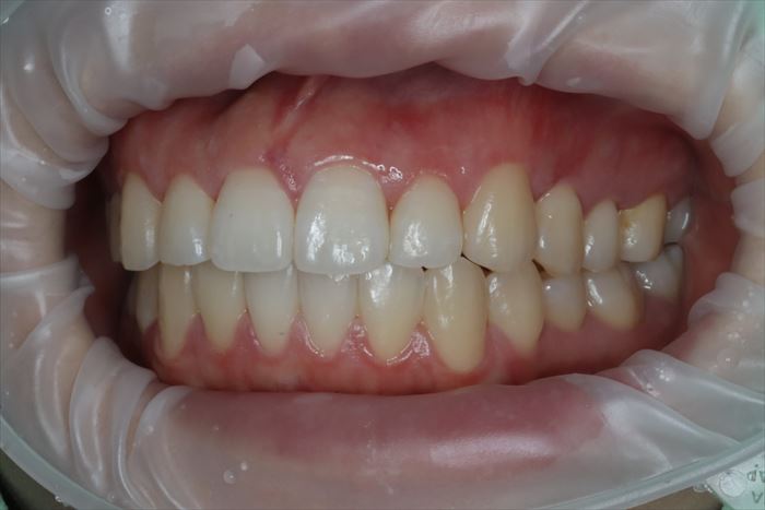 マウスピース矯正治療クリアコレクト17枚使用後の完成ゴールの状態の左側口腔内の写真
