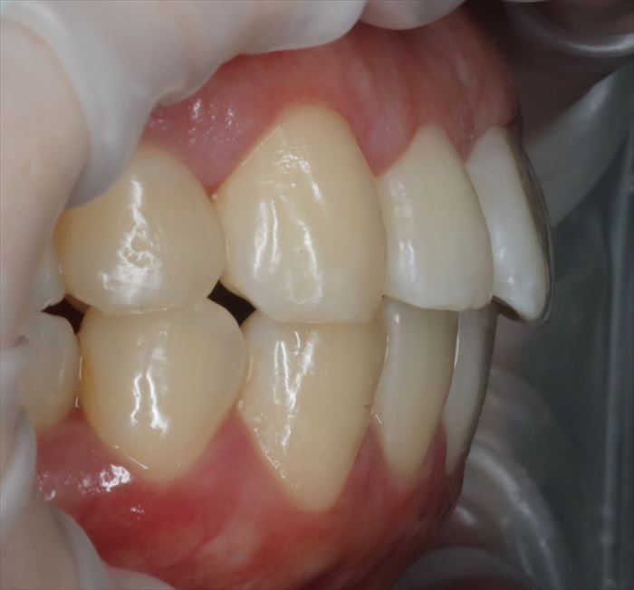 マウスピース矯正治療クリアコレクト17枚使用後の完成ゴールの状態の上顎前歯右側面の写真