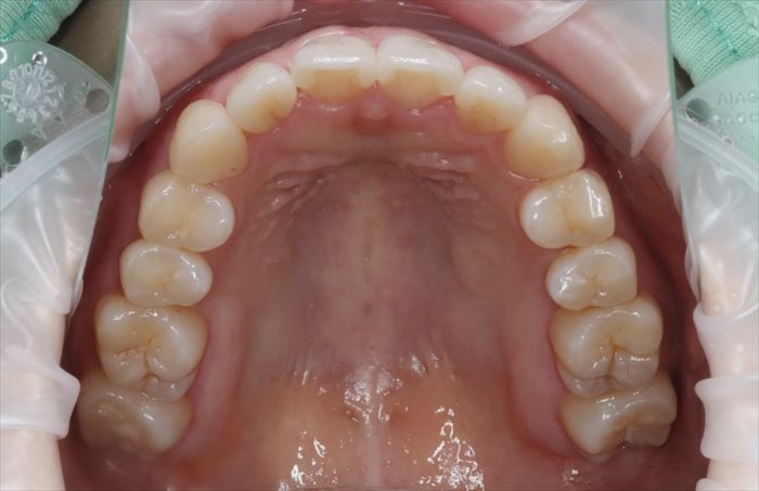 マウスピース矯正治療クリアコレクト17枚使用後のゴールの状態の上顎咬合面観写真