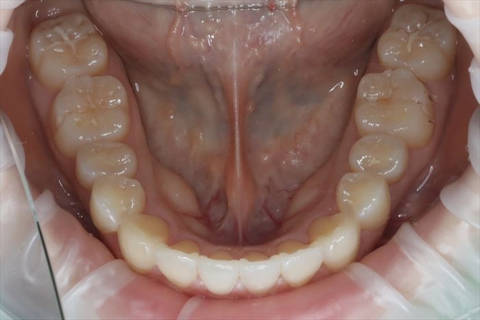 マウスピース矯正治療クリアコレクト17枚使用後のゴールの状態の下顎咬合面観の歯列がきれいにアーチ状に並んだ写真