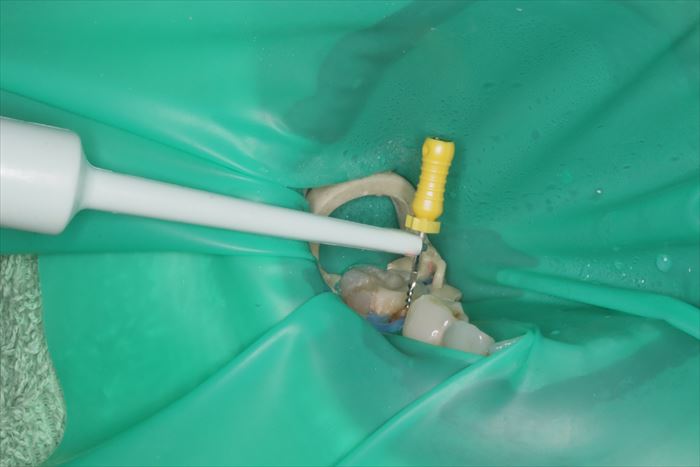 ラバーダムを装着して右下第二小臼歯の電気的根管長測定を行っている場面の写真