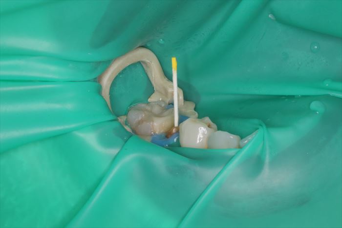 ラバーダムを装着して薬液洗浄後の右下第二小臼歯の根管を滅菌ペーパーポイントで吸水乾燥している場面の写真