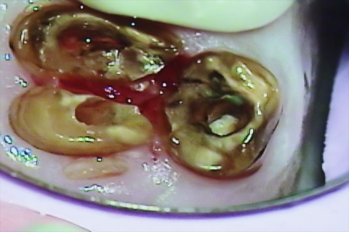 ボロボロに朽ちている左上奥歯を抜歯するために分割した場面の写真
