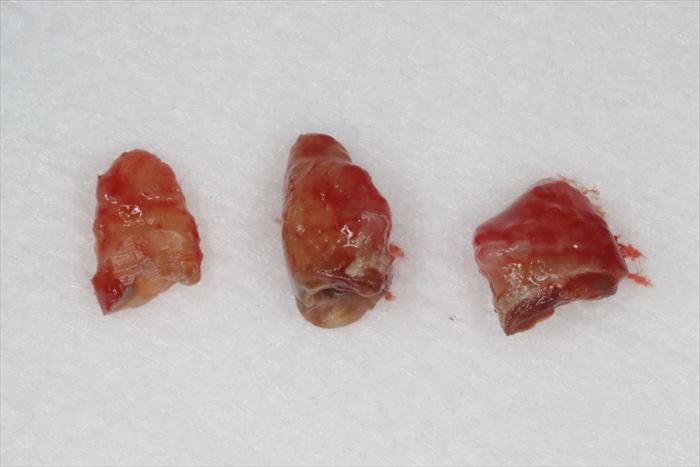 炎症が起きて歯肉がまとわりついている抜歯した左上第二大臼歯の写真