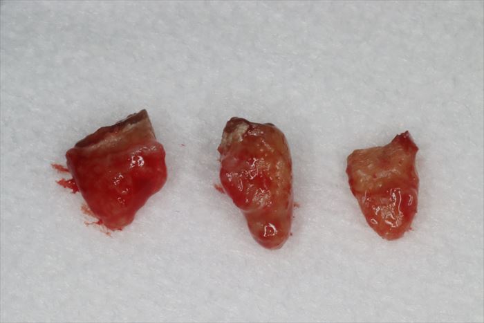 歯根分割して抜歯した左上第二大臼歯の写真