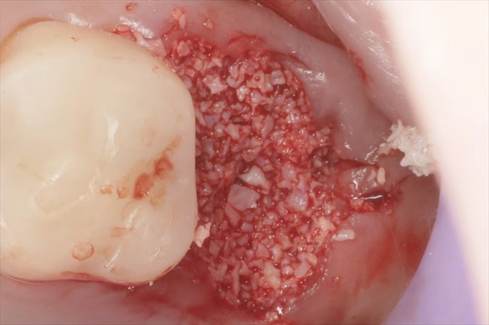 ボロボロに朽ちている左上奥歯第二大臼歯の抜歯を終え、内部に骨移植材Bio-Ossを填入した場面の写真