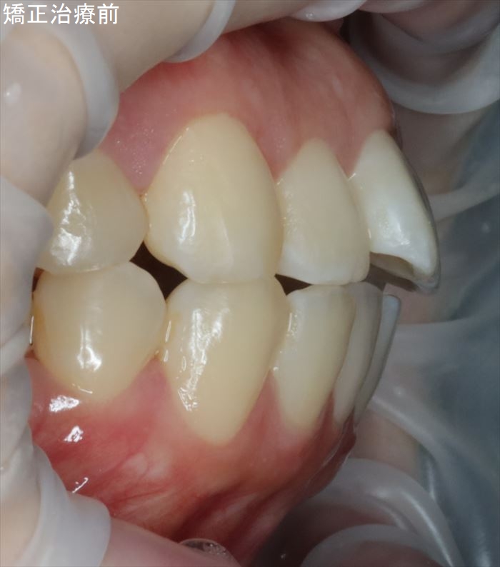 マウスピース矯正治療クリアコレクト治療前の上顎前歯の出っ歯（上顎前突）の状態の写真