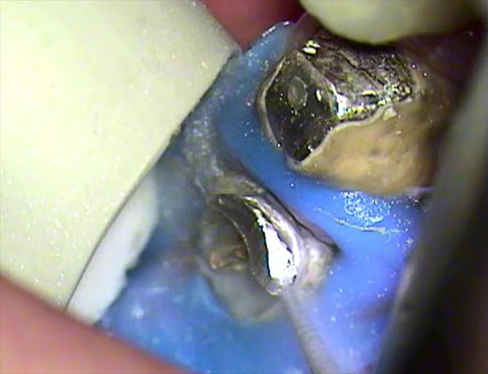 ラバーダムを装着することが不可能な歯の場合、ゴム状のプラスチックで周囲を保護して金属を切削する場面の写真