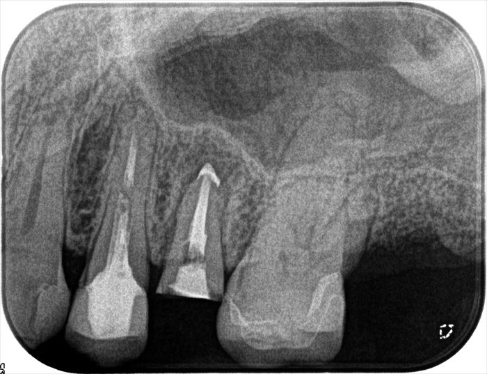歯根の先端に膿が溜まっていた左上第二小臼歯の根管充填後のレントゲン写真・根充デンタル