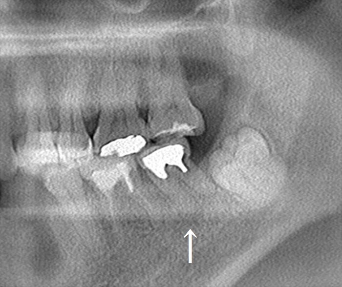 メタルコアがセットされている左下第二大臼歯のパノラマレントゲン写真