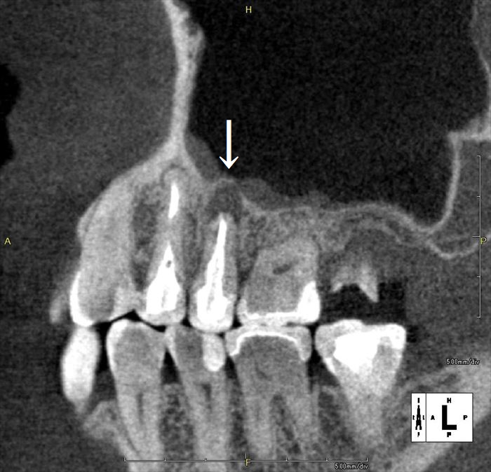 左上第二小臼歯の歯根の先端に膿が溜まっている状態のCT断層撮影像の写真