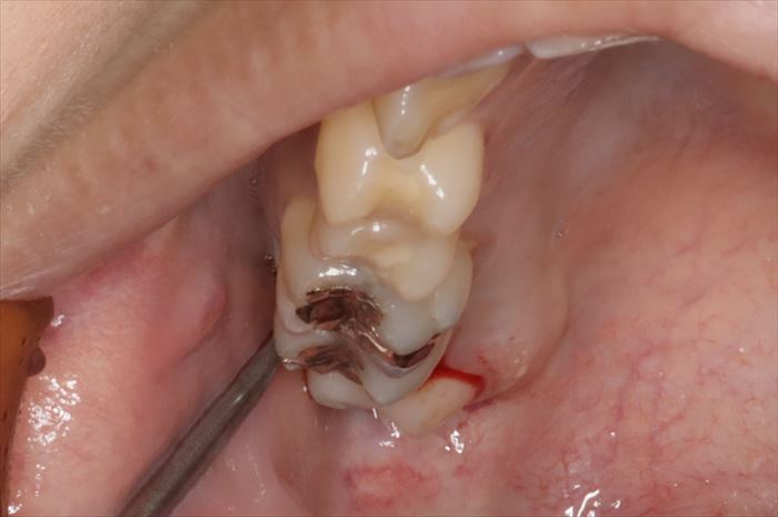 ヘーベルを右上親知らずの抜歯に用いている場面の写真