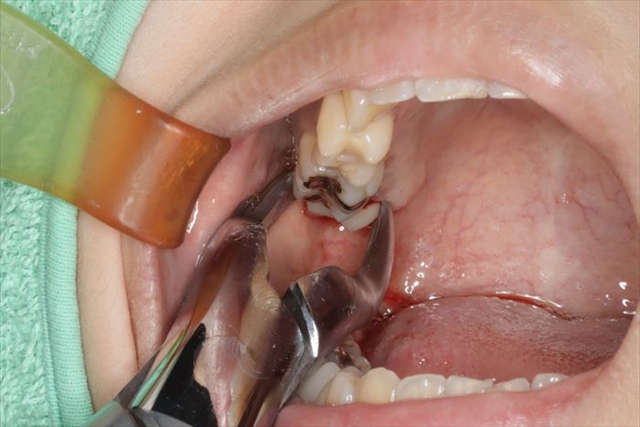 抜歯鉗子を右上親知らずの抜歯に用いている場面の写真