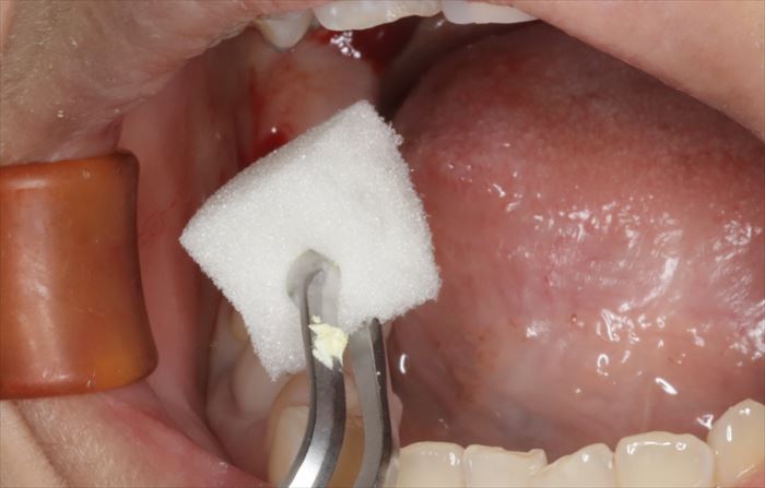 抜歯窩にスポンゼルを挿入する場面の写真