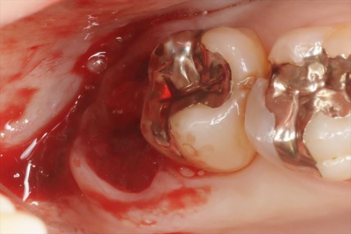 右上親知らずの抜歯窩にスポンゼルを挿入した状態の写真