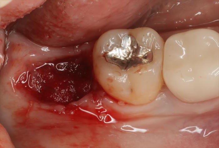 右下親知らずの抜歯窩にスポンゼルを挿入した場面の写真