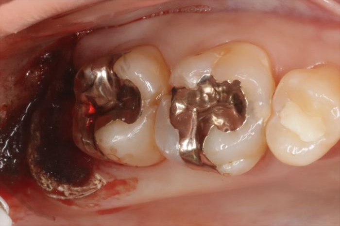 右上親知らずの抜歯窩にCO２レーザーを照射して治癒促進を図った写真