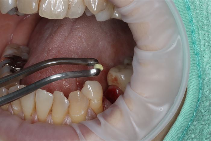 TCコーンを抜歯窩に挿入する場面の写真