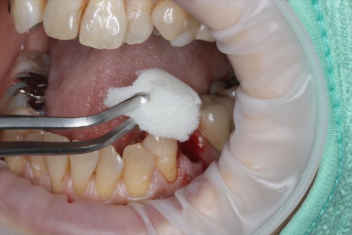 抜歯窩にスポンゼルを挿入する場面の写真