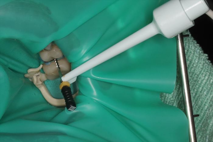 左上第二小臼歯の再根管治療時に電気的根管長測定を行っている場面の写真