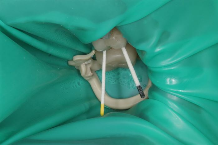 左上第二小臼歯の根管充填前に滅菌ペーパーポイントで吸水乾燥している写真