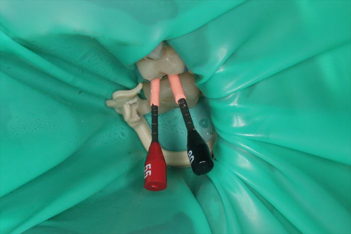 左上第二小臼歯にサーマフィルによる垂直加圧根管充填を行った写真