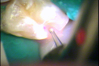右下第二小臼歯の過去のコンポジットレジン修復を削って取り除くGIF動画