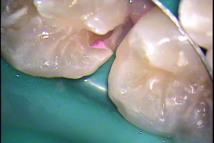 エナメル質と象牙質の間からむし歯（う蝕）が進行している部分をう蝕検知液で染色した写真