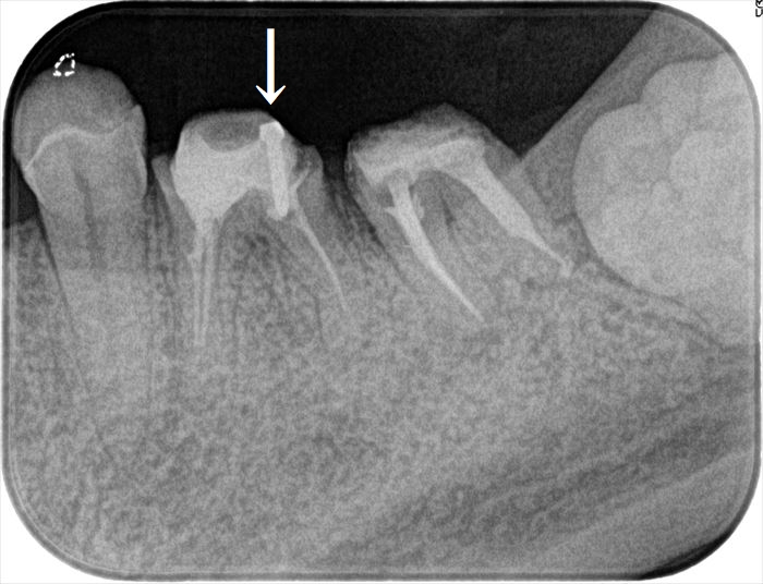 スクリューポストが入っている左下第一大臼歯のレントゲン写真