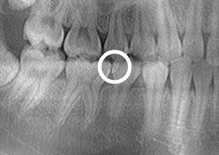 右下第二小臼歯の遠心隣接面に存在している過去のコンポジットレジン修復が外れて浮いているレントゲン写真