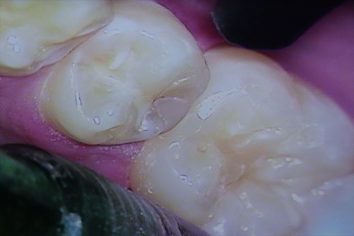 右下第二小臼歯の遠心隣接面に存在している過去のコンポジットレジン修復が外れて浮いている写真