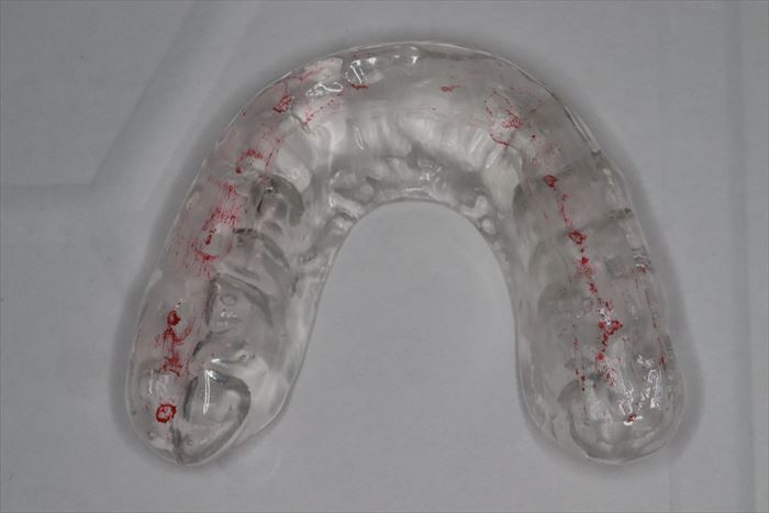 顎関節症、食いしばり、歯ぎしり用マウスピースの下の歯との接触を咬合紙で印記した写真