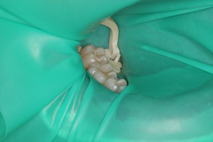 右下第二小臼歯の治療のためにラバーダムを装着した写真