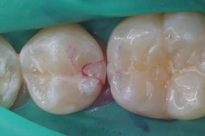右下第二小臼歯の遠心隣接面の過去のコンポジットレジン修復が外れている部分に色素を流して洗った写真