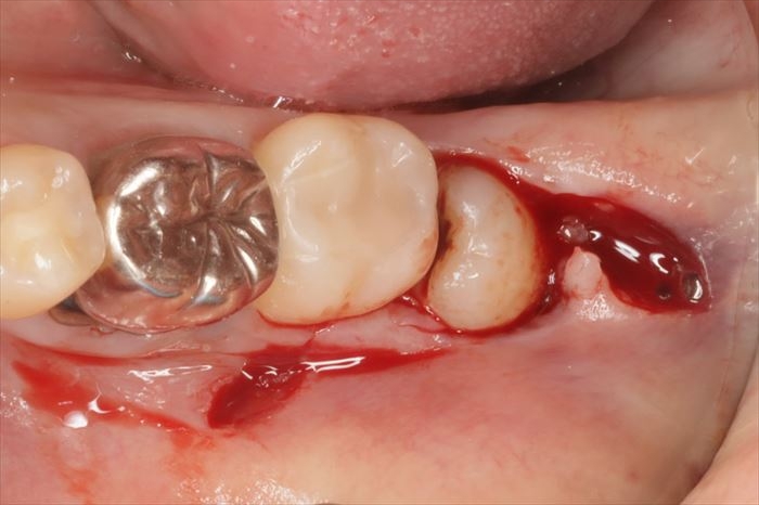 左下水平半埋伏智歯の抜歯の為、切開を加えた写真