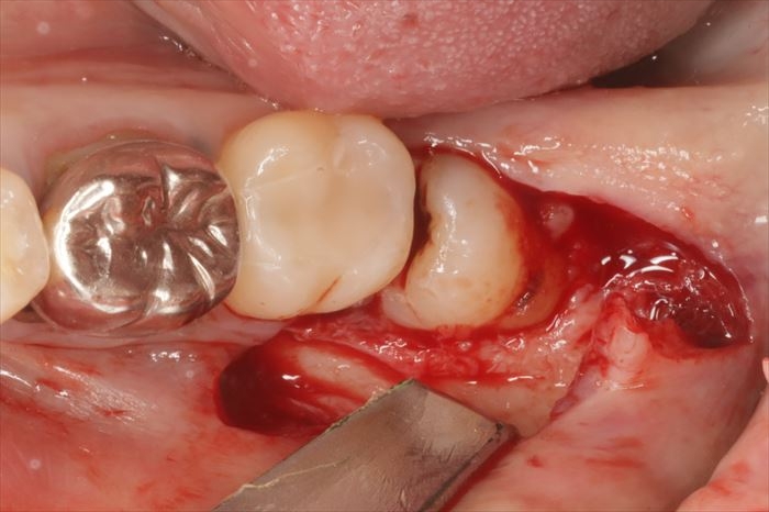 左下水平半埋伏智歯の抜歯のため、粘膜弁（歯肉フラップ）を開けた写真