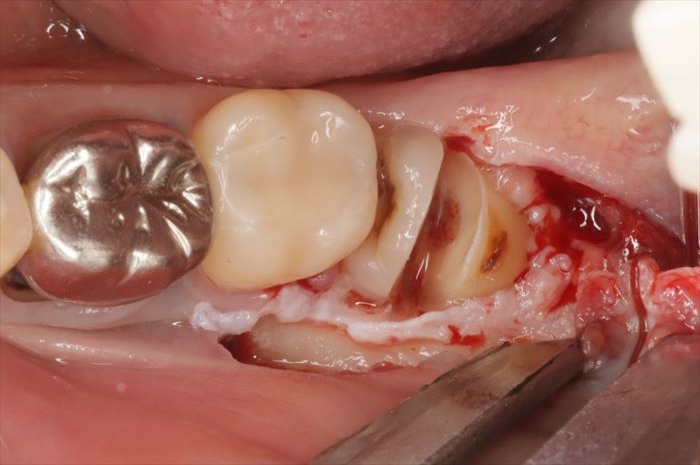 左下水平半埋伏智歯抜歯のため歯冠と歯根に二分割した写真