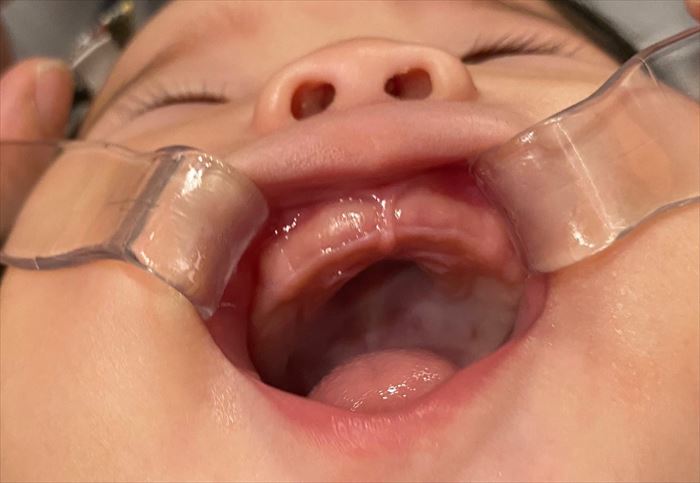 生後6ヶ月の赤ちゃんの上顎歯ぐき