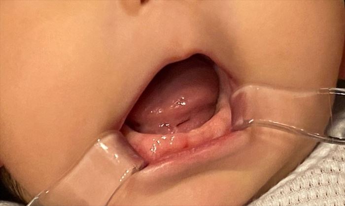生後6ヶ月の赤ちゃんの下顎歯ぐきのアップ写真