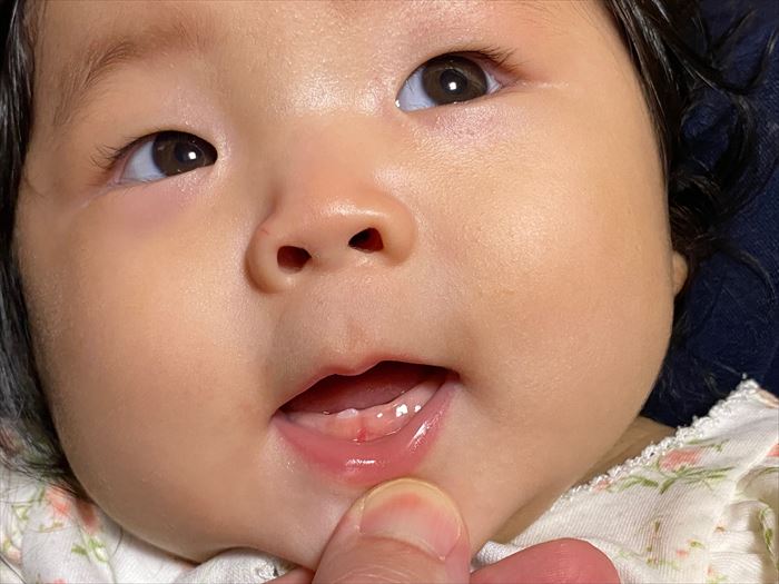 生後6ヶ月の赤ちゃんの下顎の乳歯が生えてきた写真