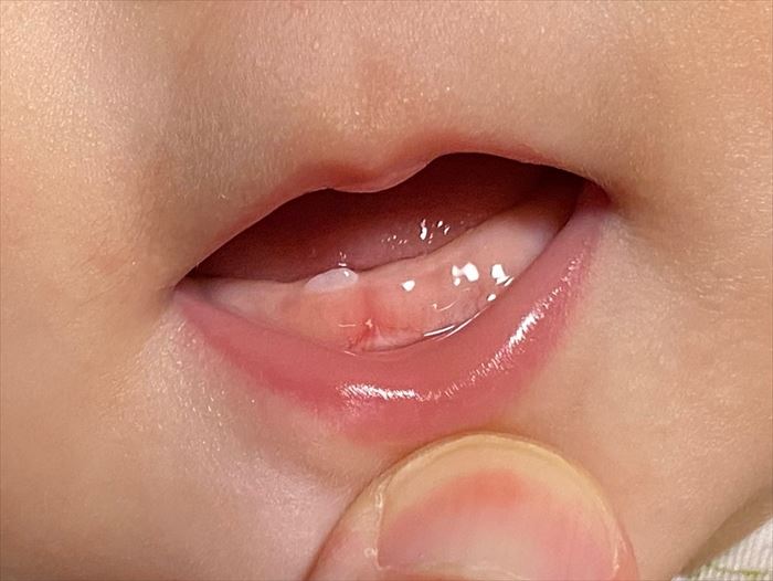 生後6ヶ月の赤ちゃんの下顎の乳歯（乳中切歯：右下A）が生えてきた写真