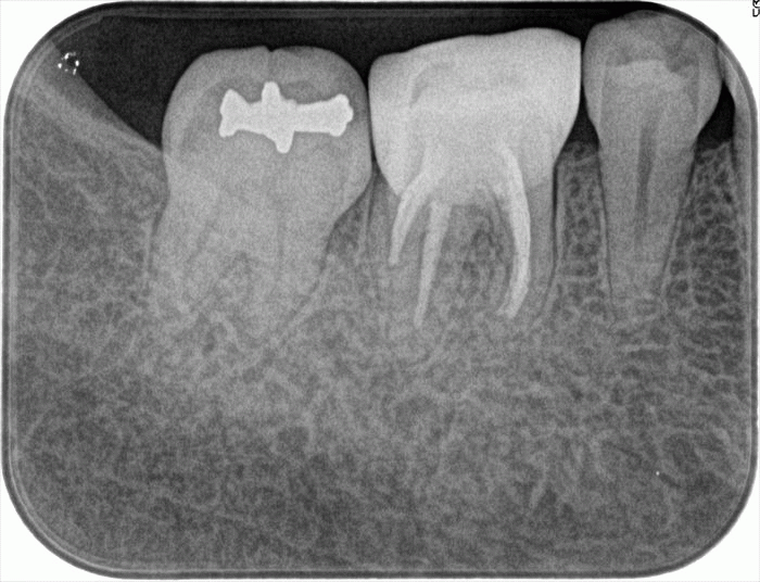 神経取ったのに違和感があった歯｜根管充填からセラミックの歯の完成｜2023.08.03